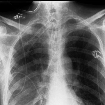 Chest X-ray